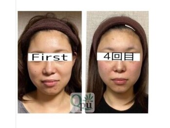 キュープ 静岡店(Qpu)/小顔矯正×リンパマッサージ