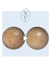 ナビ(NAVI)/毛穴詰まり／黒ずみ／くすみ