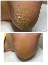 プラスキュア 用賀店(+CURE)/【フットケア】　角質ケア￥6050