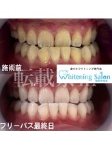 ホワイトニングサロン 福岡天神店/ホワイトニング