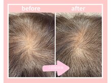 ピエルポゼ(Piereposer)/エクソソームで育毛促進！