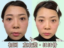 ナチュラルビューティーフェイス 横浜(NBF)/顔の印象を変える歪み/造顔