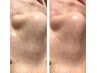 【毛穴詰まり・黒ずみ改善】触って実感　水素水×吸引のパワーで毛穴の大掃除