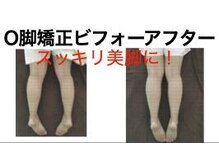 やち鍼灸院/O脚矯正で美脚に！