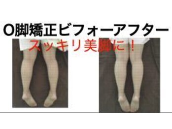 やち鍼灸院/O脚矯正で美脚に！