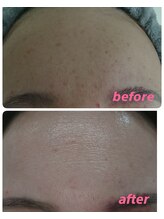 アズ(AZU)/40代before after