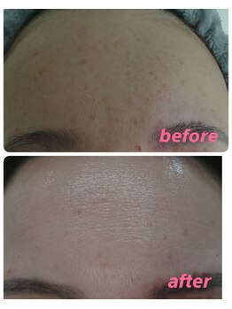 アズ(AZU)/40代before after