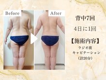 ミスティア(mistia)/【セルフエステBA】背中