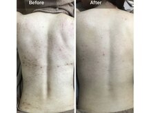 モカ 天王寺店(MOKA)/背中　ハーブピーリング　くすみ