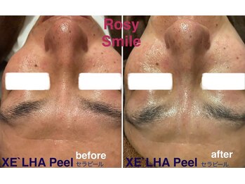 ロージースマイル(Rosy smile)/【韓国肌管理★ セラピール 】