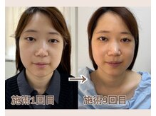 ルビーミー(Ruby's Me)/美顔筋テラボーラー症例