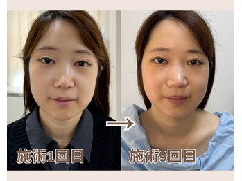 ルビーミー(Ruby's Me)/美顔筋テラボーラー症例