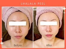 シロカネ 光の森店(SHIROKANE)/韓国肌管理ララピール☆