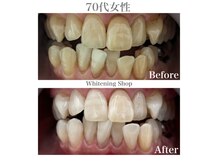 ホワイトニングショップ 広島廿日市店/before&after