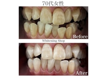 ホワイトニングショップ 広島廿日市店/before&after
