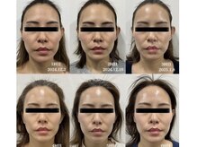 グロウラ(GrowRa)の雰囲気（エステ６回で肌に透明感と艶が生まれ、シワたるみの改善に効果！）