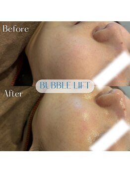 バブルビューティー(Bubble beauty)/LDM水玉リフティング