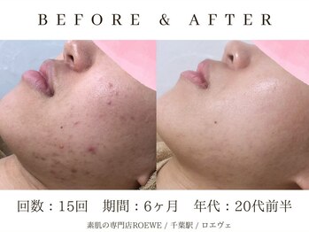 ロエヴェ(ROEWE)/ニキビ改善・毛穴ケア・肌質改善