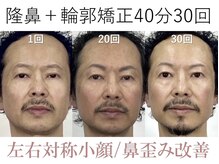 ラプリ 大阪心斎橋店(Raplit)/隆鼻＋輪郭矯正40分30回