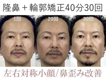 ラプリ 大阪心斎橋店(Raplit)/隆鼻＋輪郭矯正40分30回