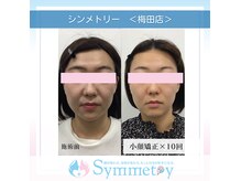 小顔矯正専門店 シンメトリー 梅田の雰囲気（むくみ/エラ/左右差/ほうれい線などのお悩みを改善し即効小顔!!）