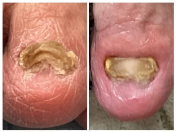 アンティ(Aunty)/肥厚した爪