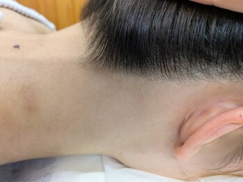 ブルーココア(BlueCocoa)/襟足脱毛