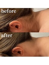 ミノア 熊本店(MINOA)/うなじ脱毛◆ビフォーアフター