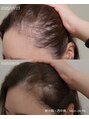 サロンドリー(salon de Re) コロナにかかり毛が抜けてしまった私自身のプロセルの変化です