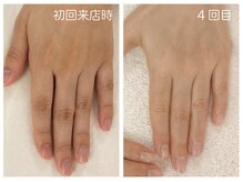 キレイテ 上野店/30代/5回目【東京ハンドケア】