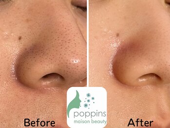 メゾンビューティーポピンズ 恵比寿(maisonbeauty poppins)/フェイシャル　毛穴ハイドラ