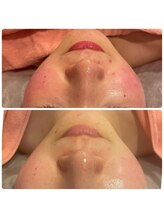 ヒメミ(Himemi)/ＢＢＬ光エステ