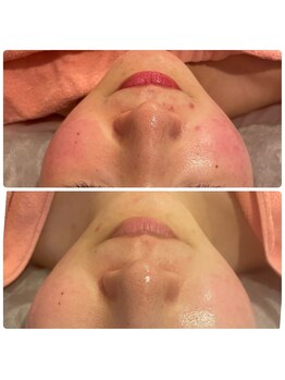 ヒメミ(Himemi)/BBL光エステ