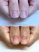 マリーロール 梅田店(Marie Laure)/深爪矯正/自爪育成/自爪風