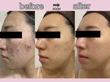 サクラ スパ(SAKURA SPA)/フェイシャル『ADSプログラム』