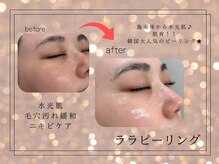 スア(SUA)/ララピールビフォーアフター