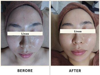 リノア(Linoa)/before/after