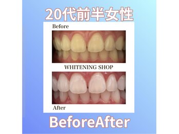 ホワイトニングショップ 西原店/20代前半女性☆BeforeAfter