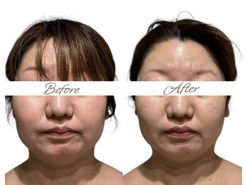 マヌレニ(manuleni)/別人級変化は当院フルコースで◎