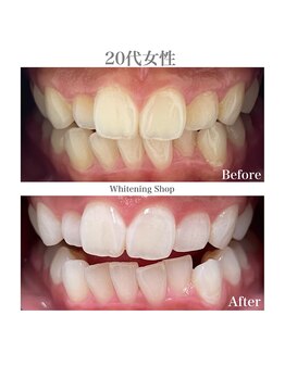 ホワイトニングショップ 広島廿日市店/before&after