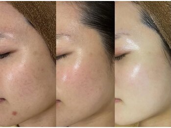 ピエル 柏店(PIEL)/ララピールで艶肌へ☆