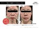 シエルビューティークロップ(Ciel Beauty CROP)の写真/高濃度エクソソーム導入で肌悩みにアプローチ！シミシワたるみニキビケアは◎短期集中♪