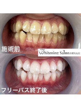 ホワイトニングサロン 京都烏丸店/ホワイトニング施術例