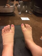 オーサポート(O-support)/アーチ作成の為のテーピング