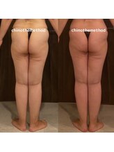 エミナル(EMINALu)/筋膜の捻じれ凸凹脂肪