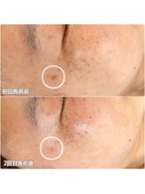 クラルス(clarus)/終わりがあるシミケア