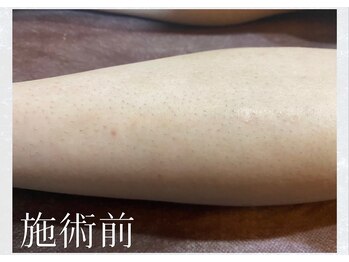 サロンドウルス(salon de ours)/メンズ　ヒザ下脱毛☆