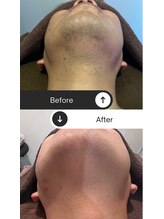 メンズアンジュ(Men's Ange)/ビフォーアフター