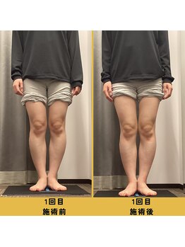 ベル/【20代会員様】O脚矯正の変化
