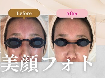 フェルナ 上新庄店(FERNA)/フェイシャル